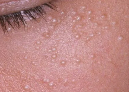 cholesterol deposits vs milia