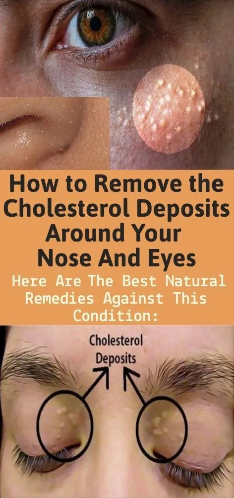 cholesterol deposits vs milia