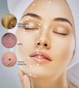 cholesterol deposits vs milia